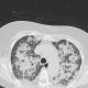 Atypical pneumonia, crazy-paving pattern, follow-up: CT - Computed tomography